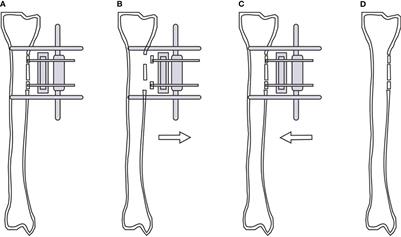 Modified tibial cortex transverse transport for diabetic foot ulcers with Wagner grade ≥ II: a study of 98 patients